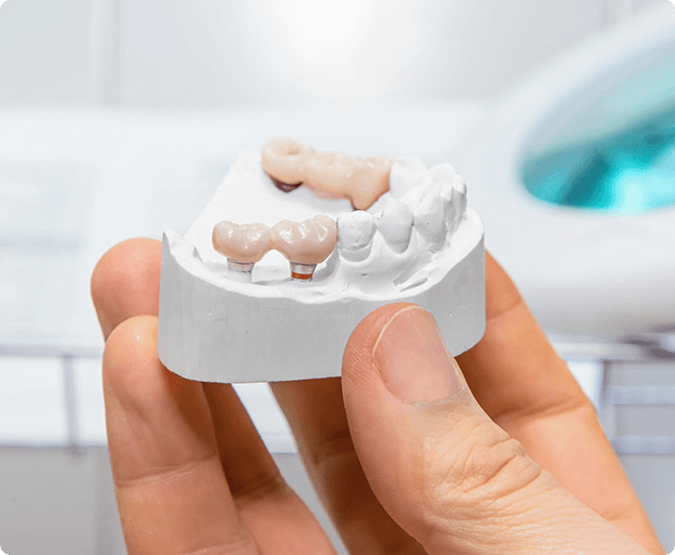 Dental Bridge Cost