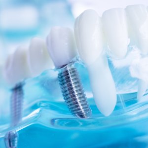 Dental Implants in Ontario