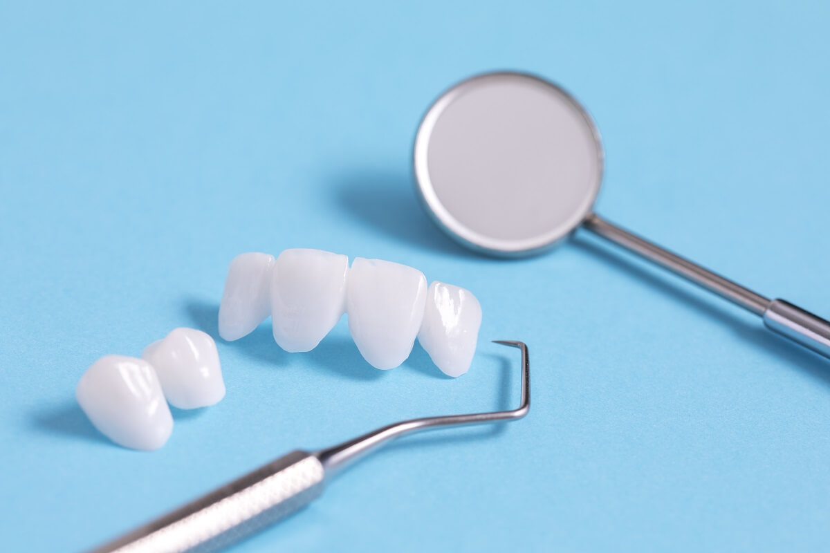 Dental Bridges vs Dental Implants