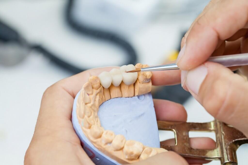 How Much Does Dental Crown Cost? Thornhill Dental Office