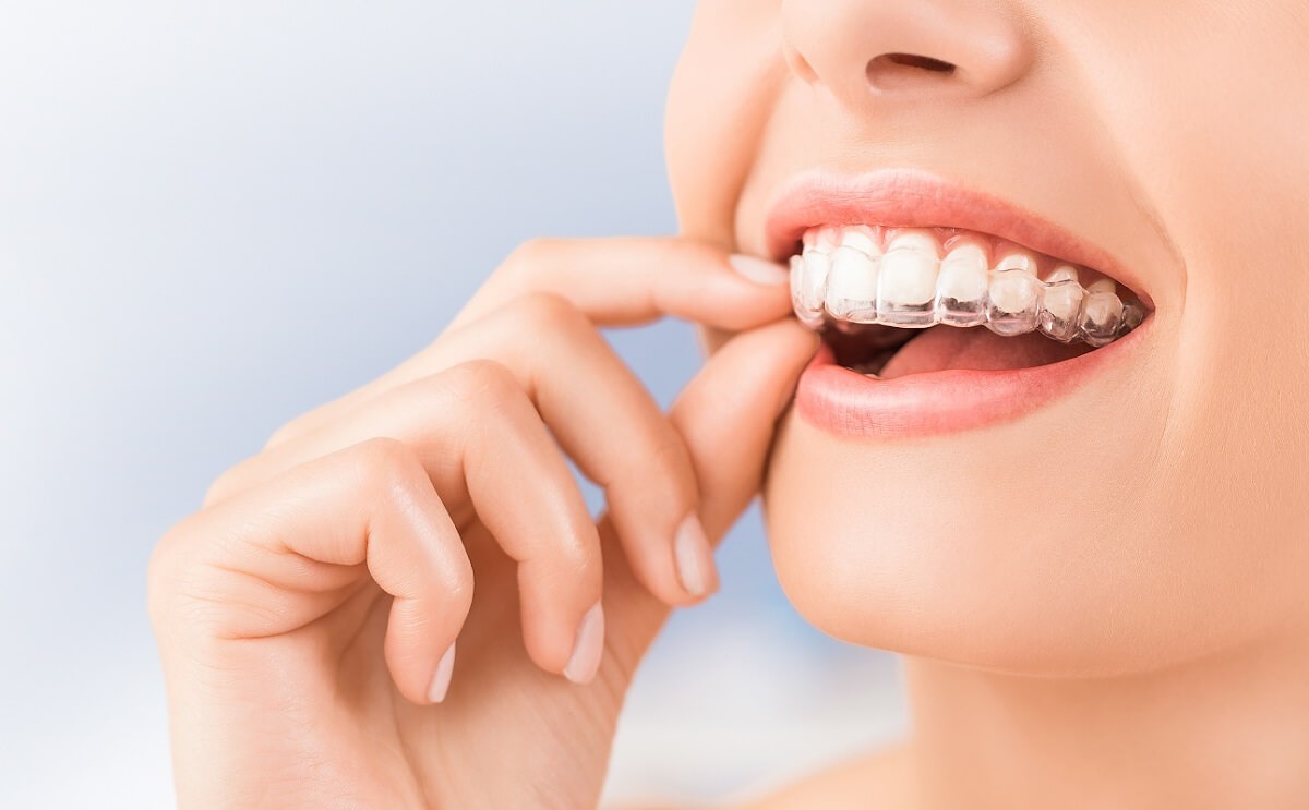What You Should Know Before Getting an Invisalign?
