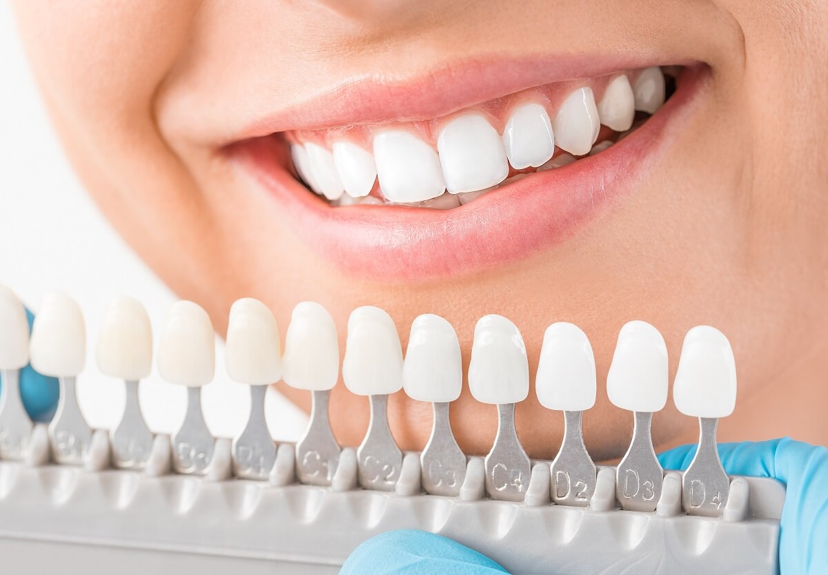 How Much Does Teeth Whitening Cost in Canada?