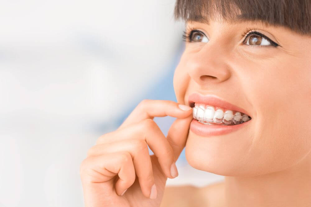 Invisalign vs Braces: Which is Better? - Thornhill Dental Office