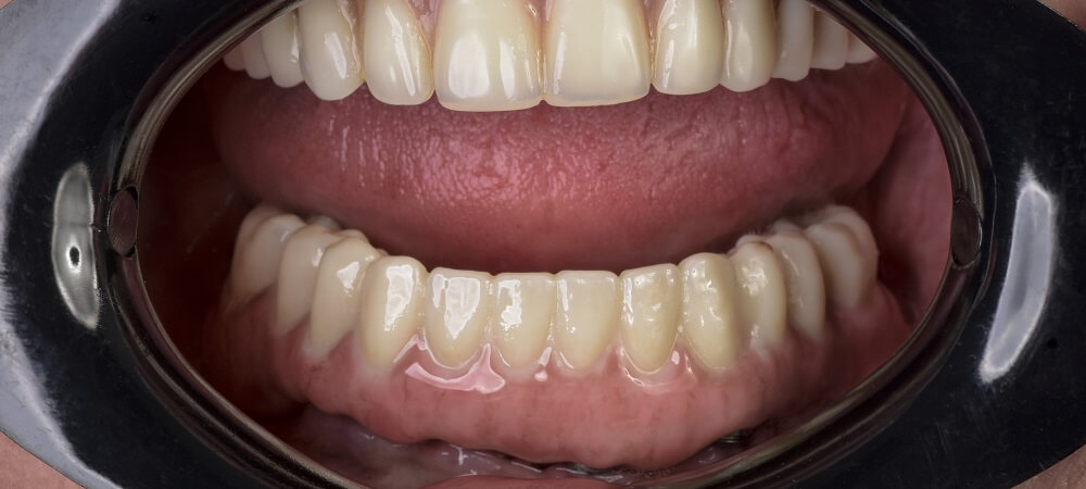 Full Mouth Reconstruction Benefits, Cost, Procedures
