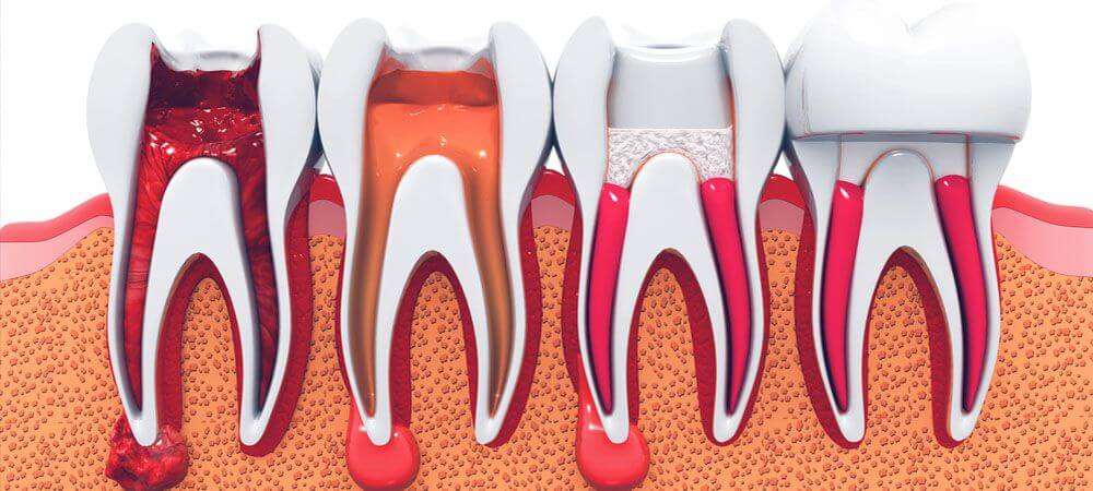 Everything You Need to Know About Root Canal Treatment - Thornhill Dental  Office