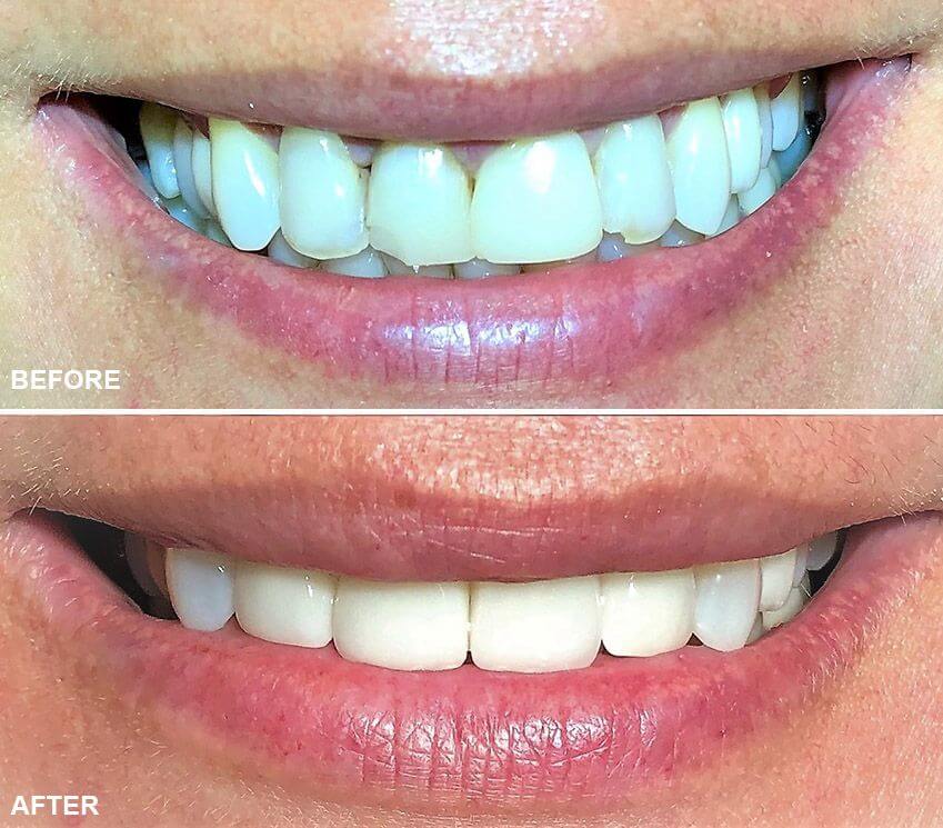 Zirconia crown before and after