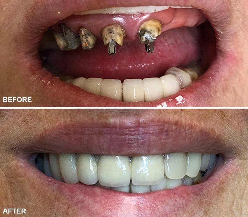 removable denture before after