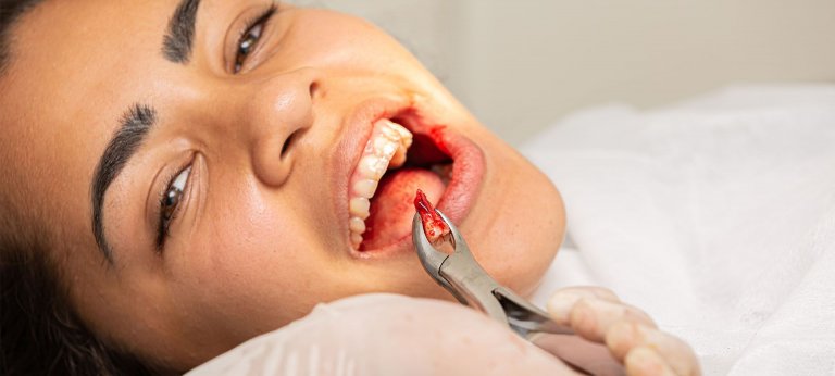 Pain Management For Wisdom Teeth Extraction