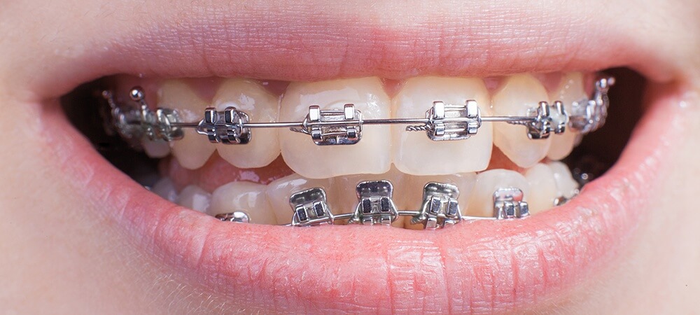 the orthodontic treatments